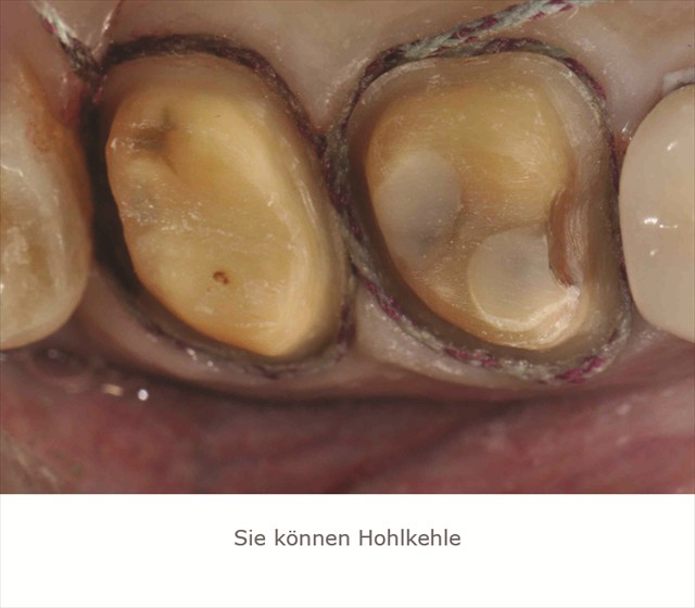 Hohlkehle+Faden