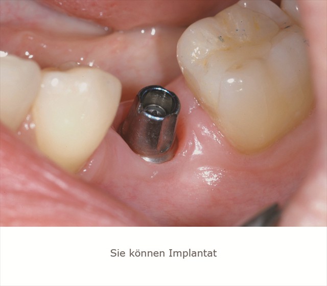 Implantat